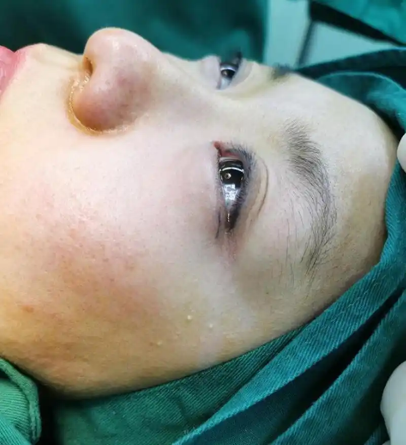 下图这位女患者下眼睑下垂,退缩,呈现三白眼,做完手术后眼神都变得
