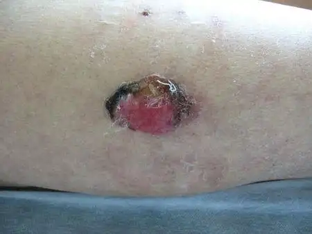 皮肤恶性肿瘤的治疗效果与其早期诊断密切相关,应注意高度可疑的