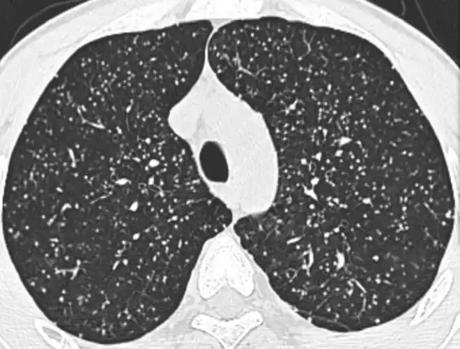 肺结核如何诊断从胸部ct到实验室检查一文讲清世界防治结核病日