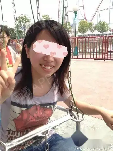 主要是虎牙突出的问题,然后那时候脸也比较圆 刚戴一个月