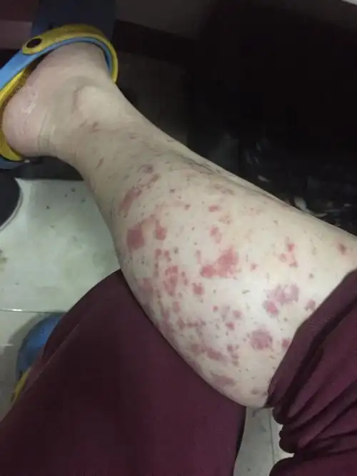 两条大腿上长了一大片红色的包,密密麻麻的伴随着瘙痒