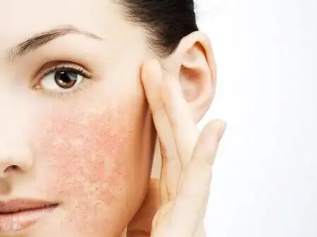 问题皮肤之"敏感肌肤"