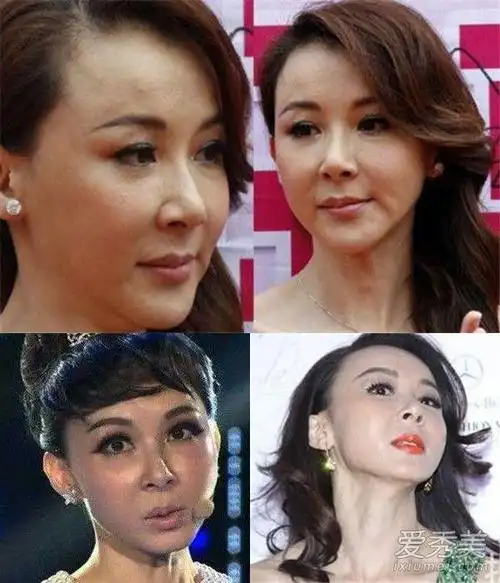 整崩的还是占多数图揭娱乐圈整容女明星现状