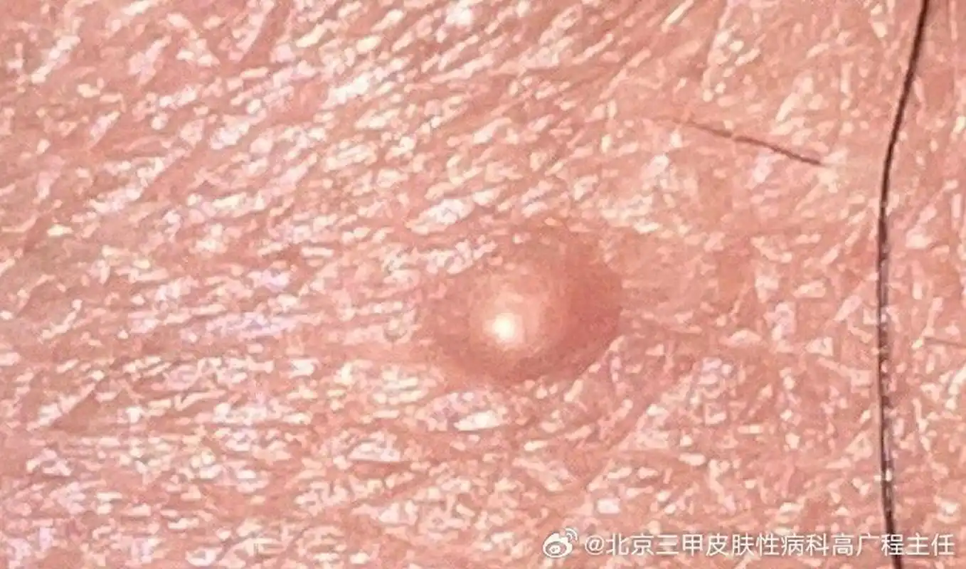 阴囊部位有个像痘痘一样的突起,不知是什么情况?