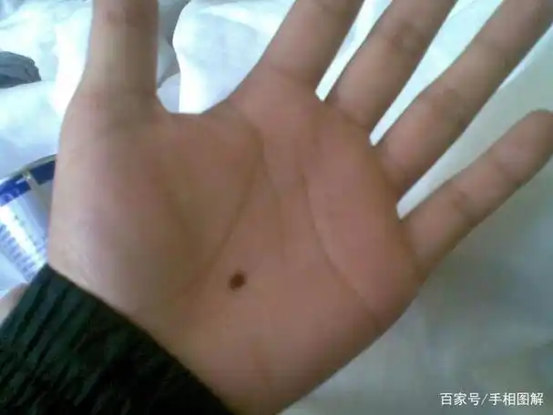 掌心痣代表了什么,手里长痣有何寓意