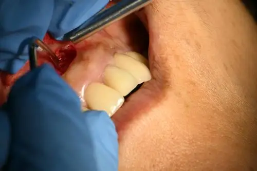 一例前牙根尖切除术