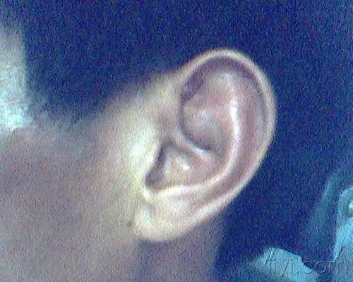 耳廓假囊肿的治疗(经验帖)