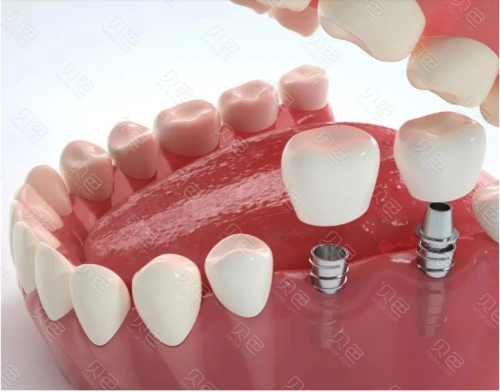种植牙安装牙冠图