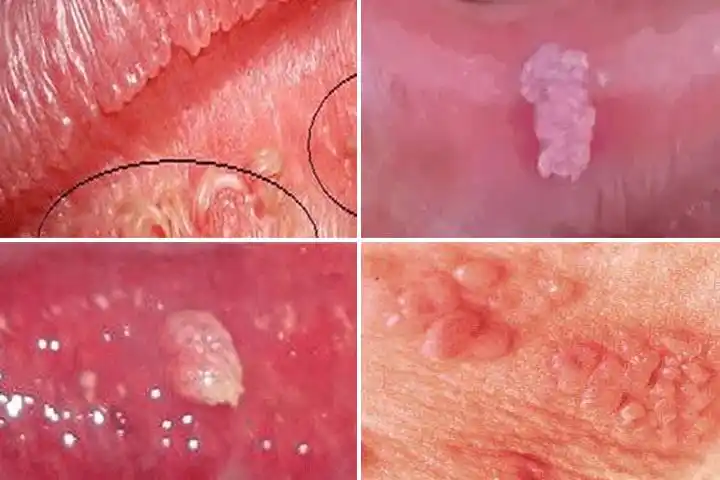 尖锐湿疣要如何自己检测能否治愈