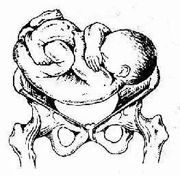 宝妈们,什么是右枕横位?懂的求指点.