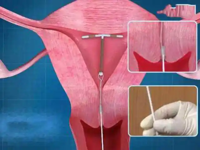 上环那么可怕生完孩子后为什么还要上环