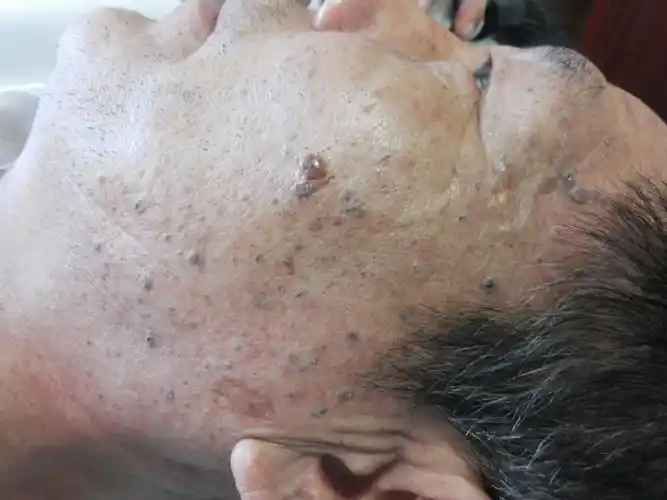 脂溢性角化斑治疗前后对比