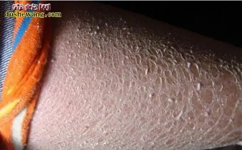 蛇皮皮肤病怎么治疗蛇皮皮肤病图片鉴别