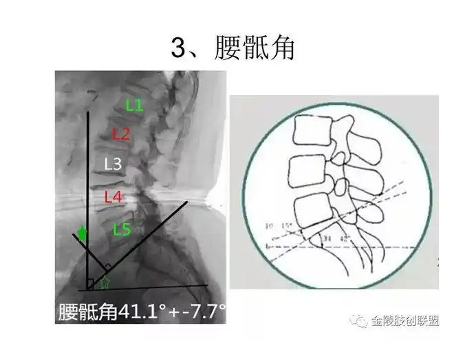腰骶角是由水平线与s1上终板所成的夹角.参考意义:正常值41.1±7.