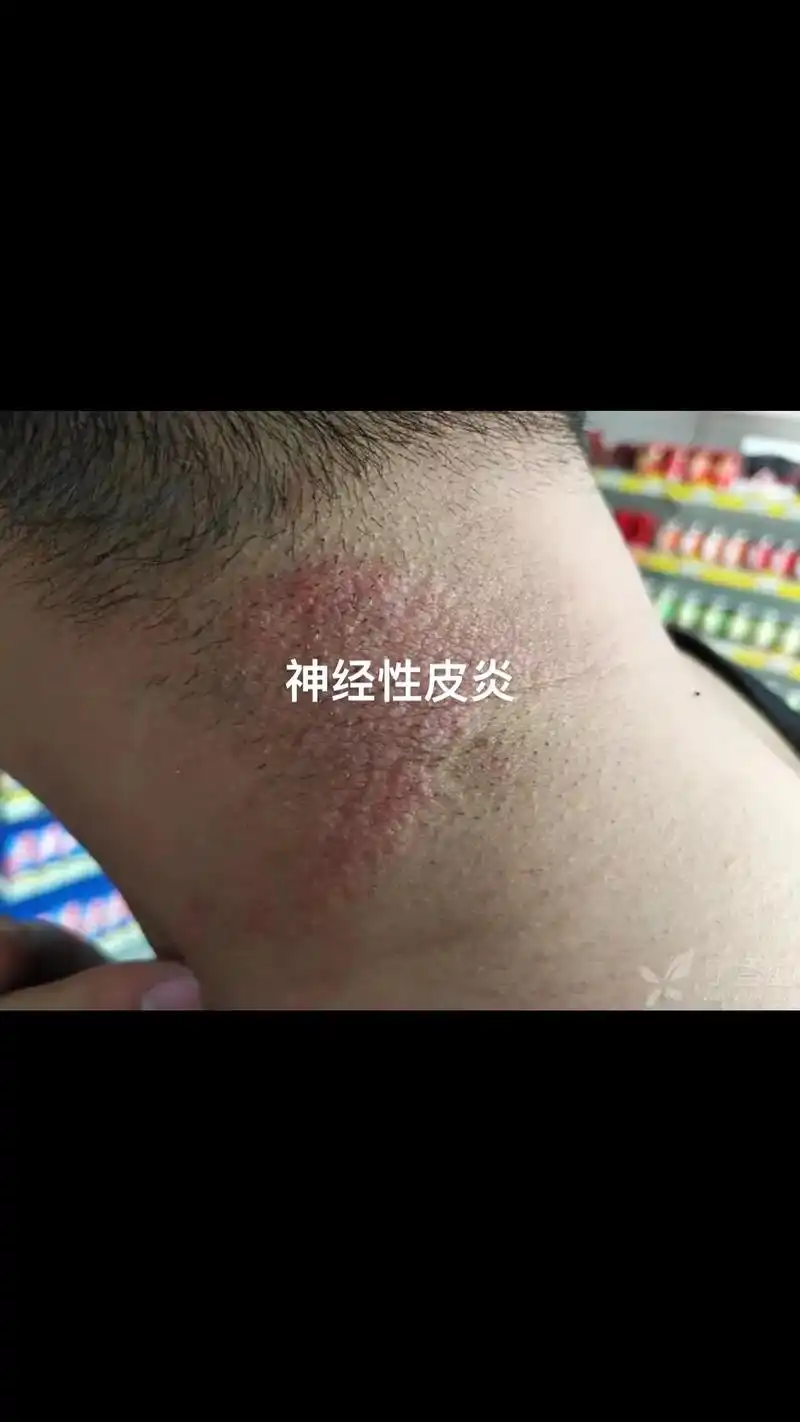 红红的皮损像苔藓一样万业警越抓越痒前后对比神经性皮炎手肘