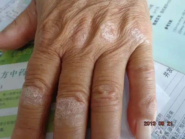 手部关节皮损