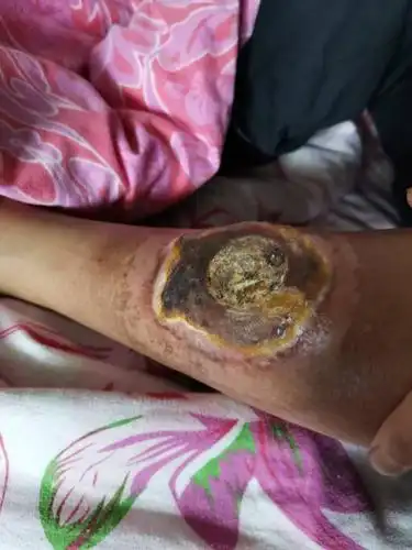 求求大家有没有关于治疗非霍奇金nkt皮肤溃烂的试验新药