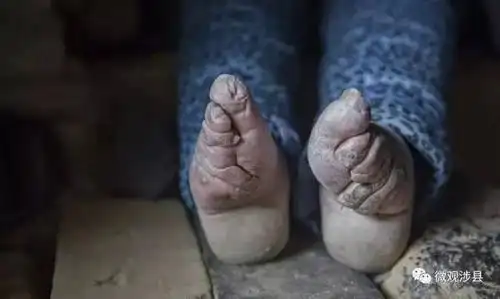 时代烙印——涉县小脚女人的"三寸金莲"
