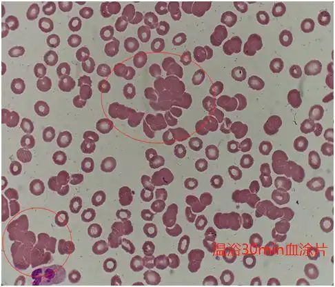 镜下密密麻麻的成团红细胞聚集,很显然就是我们常说的冷凝集现象!