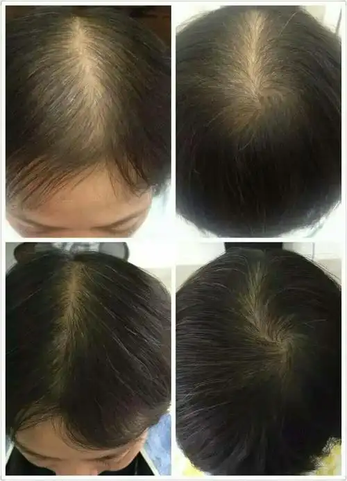 大悟章光101生发养发/防脱发/白发转黑