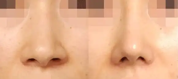 鼻翼肥大鼻头圆钝怎么办术后会留ba吗