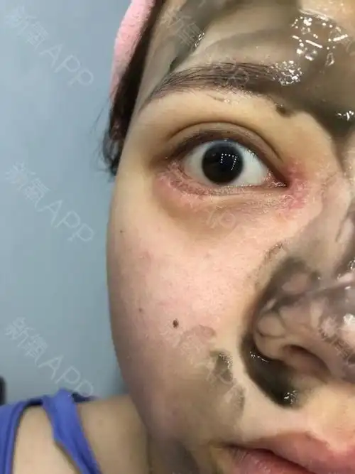 开眼角眼睑下至第11天