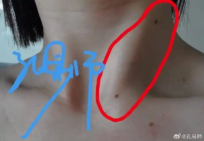 痣相脖子这类山脊状肌肉,易师称为:脖筋.脖筋有痣～～助力,抗压,护财.