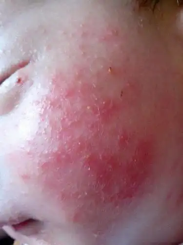 宝宝脸上湿疹,首先要看它的病因,包括看喂养,妈咪的奶喂养之后,这些