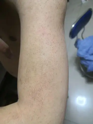 我起初是一个好朋友看到我手臂上有很多"鸡皮肤"和毛_圈子-新氧美容