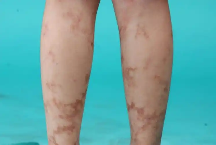 双下肢不规则形状色素斑18个月 - 皮肤及性传播疾病讨论版 - 爱爱医