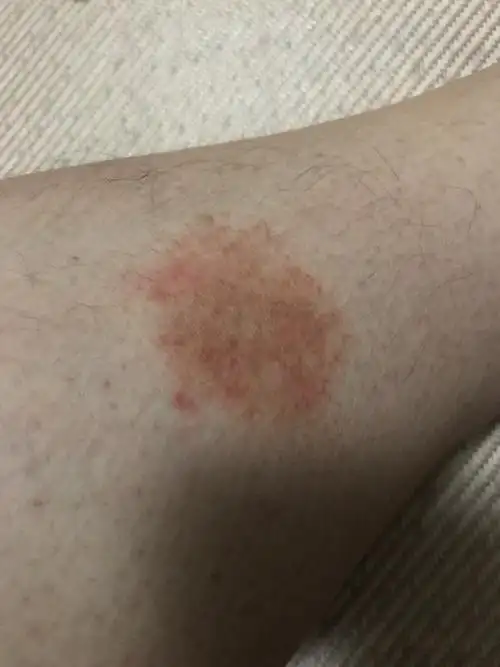 小腿上长了一块红斑不痛不痒之前是很小一块慢慢扩散变大了