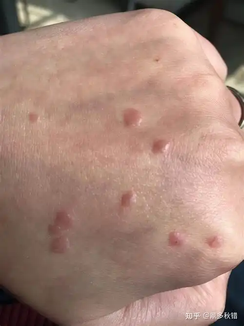 皮肤上长了小肉疙瘩可能是hpv感染