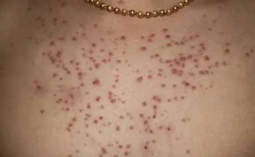 一种特殊的毛囊炎