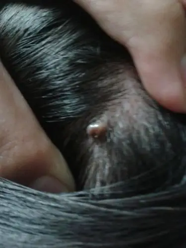 头皮上长了一个疙瘩这是什么