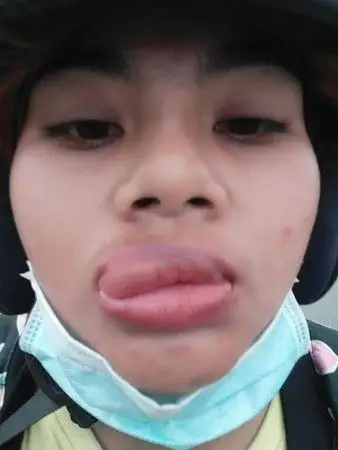 ▼▲女网友猜测应该是吃到不乾净的物质才会引发过敏.