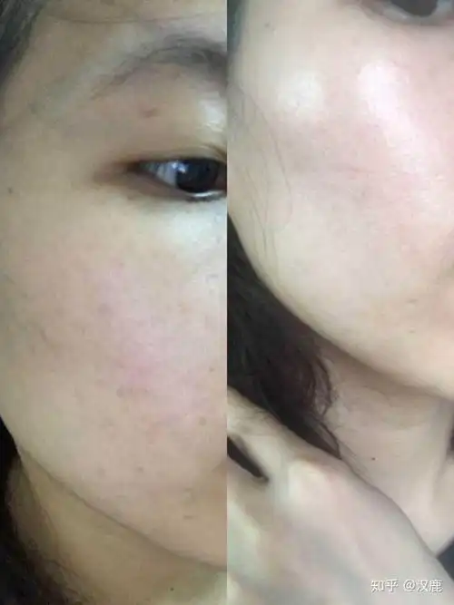 男生,95年的,皮肤粗糙毛孔大,还能养成一张干净的脸吗?