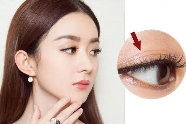 王思聪昨晚, 到底贴没贴双眼皮?