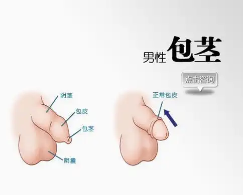 医院新闻 包皮包茎是男人发生的最多的疾病,许多的人觉得这疾病的危害