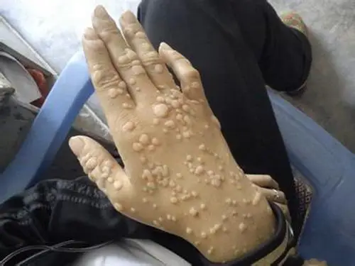 扁平疣图片_扁平疣症状表现图片大全_有来医生