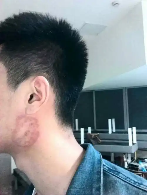 也不知道我这脖子长得什么癣?有点痒!求专家解决