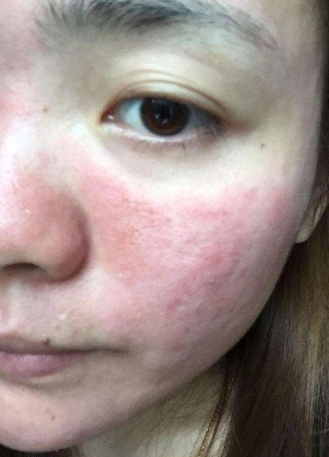 皮肤过敏图片大全