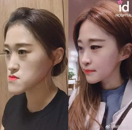 id-整容后记##双鄂手术##长脸##整形案例分享