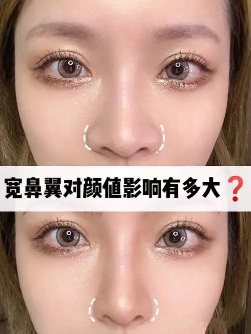 大鼻头,宽鼻翼71不是一个缩鼻翼就可以万事大吉757815_圈子