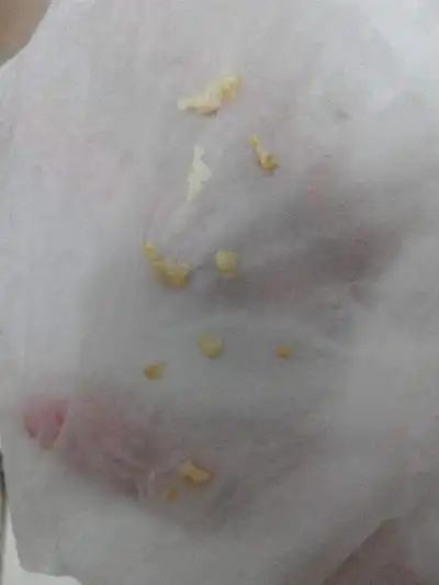 白带呈豆腐渣状图片6