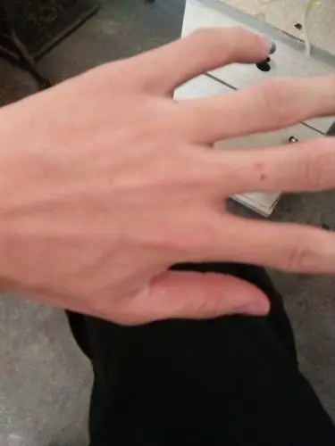 采纳率:53%擅长:暂未定制 其他回答 蜘蛛指,怀疑你患有马凡综合征