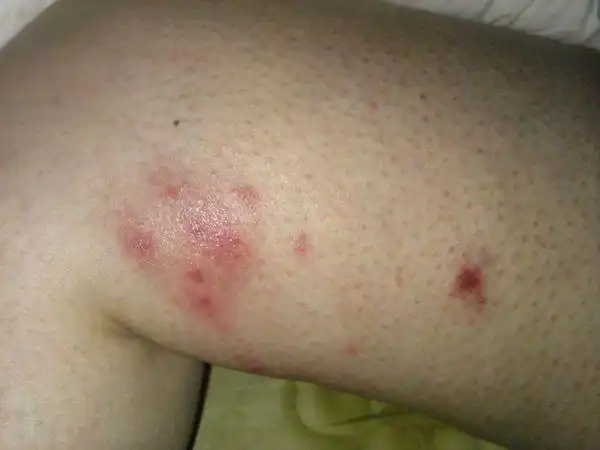 季节性皮炎,每到冬天就有,腿膝盖两侧