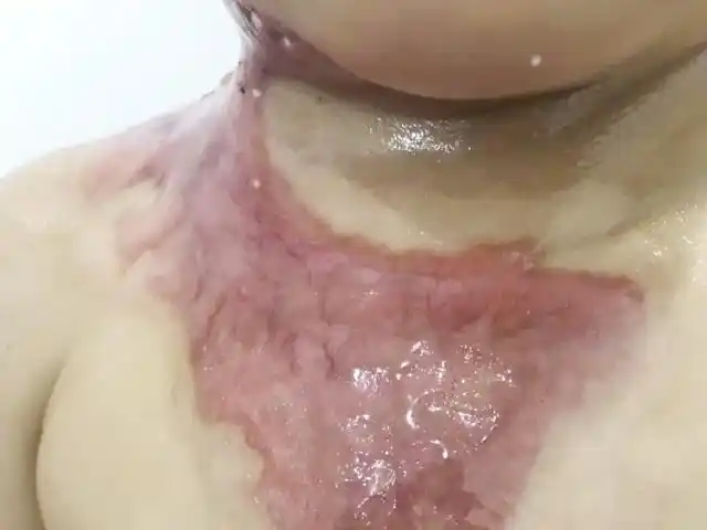 烫伤疤痕                    今年5岁的小男孩,8个月前脖子附近被