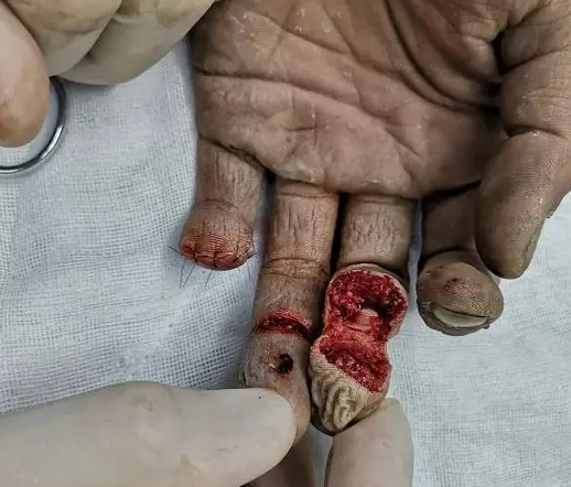 20岁年轻小伙被电锯截断手指福州专家三小时精心再指手术妥善医治