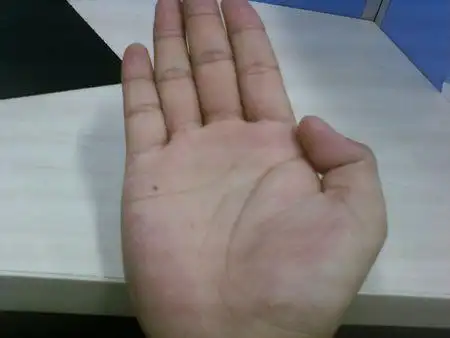 右手掌有痣啊~~~~~~ 我的右手上长了一个黑痣~~~~~在小拇指与无名指