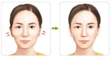 脸两边的颧骨宽怎么办不动手术颧骨外扩怎么改善